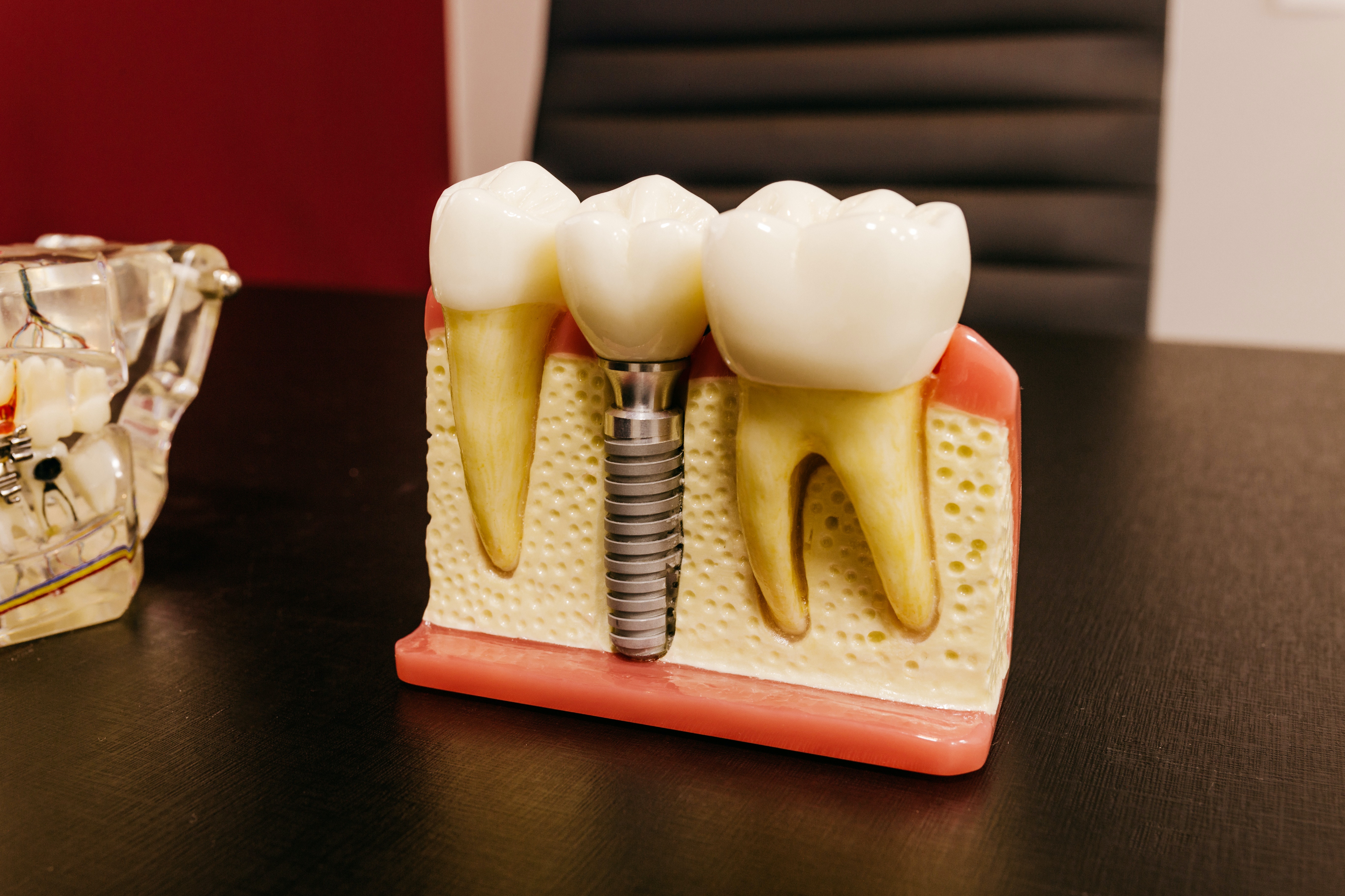 What Are Dental Implants and When to Choose to Use Them?