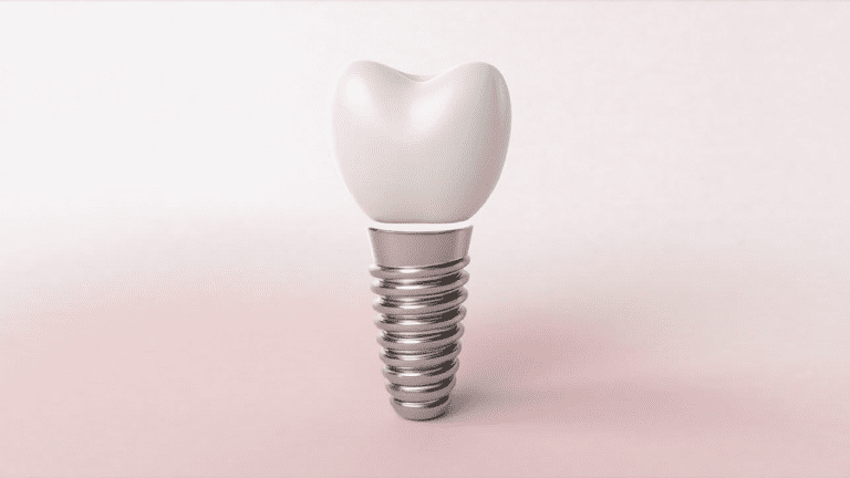 The Ultimate Guide to Dental Implants: Advancements, Benefits & Procedure