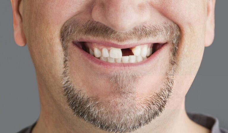 Save a Knocked-Out Tooth With Expert Tips